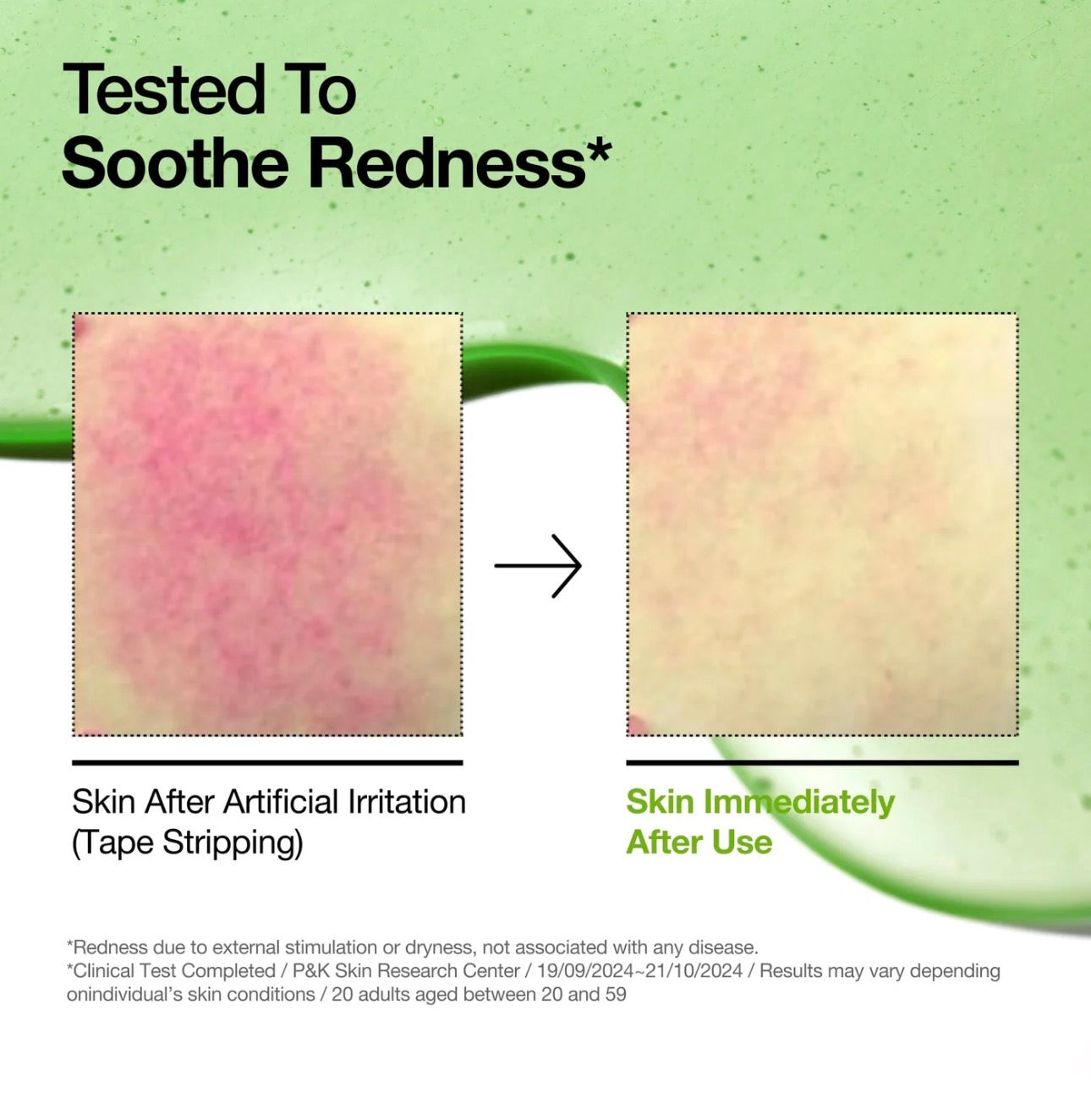ANUA Azelaid Acid 10 Hyaluron Redness Soothing Serum 30 ml